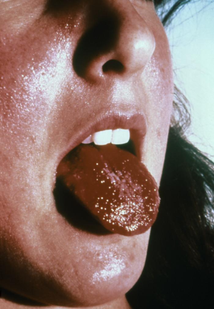 Kawasaki Disease Strawberry Tongue. strawberry tongue,kawasaki