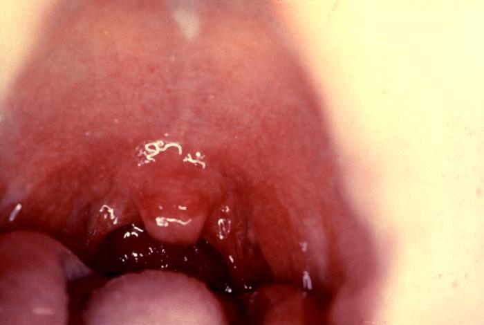  alternative throat streptococcal infection, explains how Throat